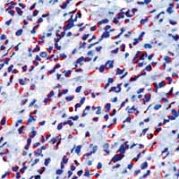 ab1819 staining human breast carcinoma by IHC-P.