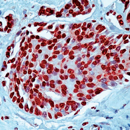 ab2412 staining Hsp70 in human breast carcinoma cells