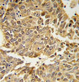 ab104263, at a 1/50 dilution, staining HIF-1-alpha in formalin fixed and paraffin embedded lung carcinoma by by Immunohistochemistry, followed by peroxidase conjugation of the secondary antibody and DAB staining.