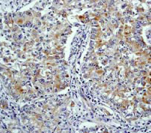 ab32092 at a 1:250 dilution staining Htr2A/ Omi in human lung adenocarcinoma, using Immunohistochemistry, Paraffin Embedded Tissue.