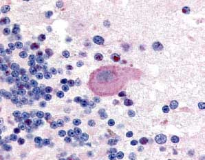 ab2174 was used at a 1:100 dilution to detect phosphorylated Huntingtin by immunohistochemistry in human brain cerebellum. Positive cytoplasmic staining is observed in neurons. Tissue was formalin-fixed and paraffin embedded. Detection was with AEC (pink), nuclear counterstaining with Haemotoxylin (blue).