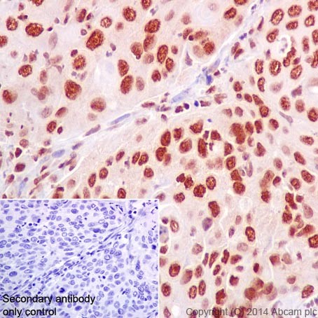 Immunohistochemical analysis of paraffin-embedded Human cervix carcinoma tissue labeling HuR / ELAVL1 with ab200342 at 1/500 dilution followed by Goat Anti-Rabbit IgG H&L (HRP) (ab97051) at 1/500 dilution. Nuclear and weakly cytoplasm staining on Human cervix carcinoma tissue is observed. Counter stained with Hematoxylin.Secondary antibody only control: Used PBS instead of primary antibody, secondary antibody is Goat Anti-Rabbit IgG H&L (HRP) (ab97051).