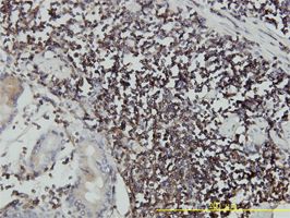 ICAM3 antibody (ab55254) used in immunohistochemistry at 3ug/ml on formalin fixed and paraffin embedded human stomach carcinoma tissue.
