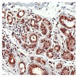 ab52116, staining human ID2 in breast carcinoma tissue by Immunohistochemistry, Formalin fixed Paraffin embedded tissue.