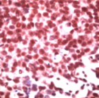 Ab41834 staining human ID3 in human breast carcinoma by immunohistochemistry using formalin fixed, paraffin embedded tissue.