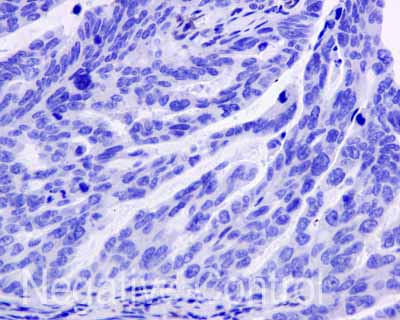 ab169788 showing -ve staining in Human gastric adenocarcinoma tissue.