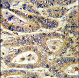 Immunohistochemical analysis of formalin-fixed, paraffin-embedded Human colon carcinoma tissue labelling IGFBP6 with ab135606 at a 1/50 dilution, followed by peroxidase-conjugated secondary antibody and DAB staining.