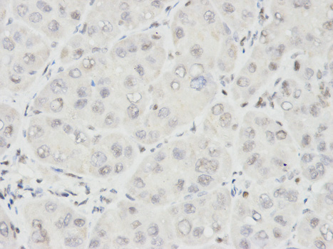 Immunohistochemistry (Formalin/PFA-fixed paraffin-embedded sections) analysis of human liver cancer tissue labelling Ikaros with ab180713 at 1/100. Magnification: 400x.