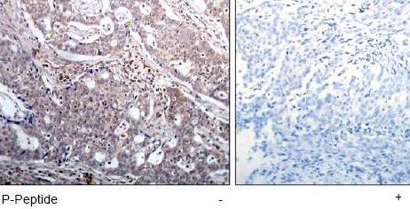 ab75746, at a 1/50 dilution, staining IkB beta in paraffin embedded human breast carcinoma tissue by Immunohistochemistry, in the absence (left image) or presence (right image) of the immunizing phospho peptide.