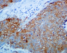ab124957, at 1/100 dilution staining IKK beta in paraffin-embedded Human cervix carcinoma tissue, by Immunohistochemistry.