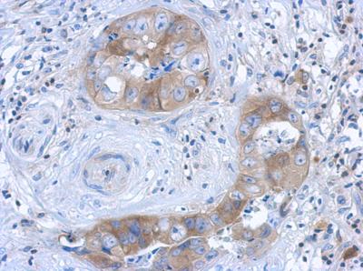 Immunohistochemical analysis of formalin-fixed, paraffin-embedded Human breast carcinoma tissue, labeling IL1 Receptor I using ab154524 at a 1/500 dilution.
