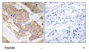 ab79277 at 1/50 dilution staining IL13 receptor alpha 1 in human breast carcinoma by Immunohistochemistry using paraffin-embedded tissue, in the absence or presence of the immunising peptide.