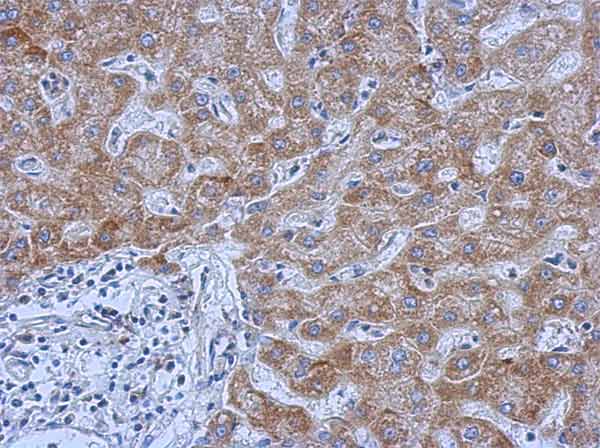Immunohistochemical analysis of paraffin-embedded Human hepatoma tissue labeling IL13 receptor alpha 1 with ab154380 at 1/500 dilution.