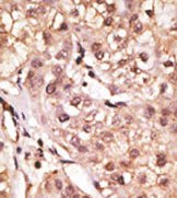 Formalin fixed and paraffin embedded human hepatocarcinoma tissue stained with ab38569, followed by AEC staining.