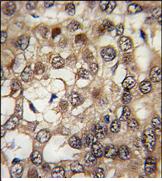 ab75937, at a 1/10 dilution, staining HIPK2 in formalin fixed, paraffin embedded human hepatocarcinoma tissue by immunohistochemistry. ab75937 was peroxidase conjugated to the secondary antibody, followed by DAB staining.