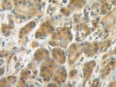 ab9622 staining IL4 in human breast invasive ductal carcinoma section by Immunohistochemistry (Formalin/PFA fixed paraffin-embedded sections). Tissue underwent heat mediated antigen retrieval in sodium citrate buffer (pH 6.0). The primary antibody was used at 0.25 ug/ml and incubated with sample at 4°C overnight. A HRP-labeled polymer detection system was used with a DAB chromogen. Additional protein blocks were used in conjuction with secondary reagents. 