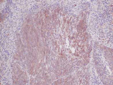 ab9324  staining IL6 in human cervical squamous cell carcinoma tissue section by Immunohistochemistry (Formalin/PFA fixed paraffin-embedded sections). Tissue underwent heat mediated antigen retrieval in sodium citrate buffer (pH 6.0). The primary antibody was used at 0.125 ug/ml and incubated with sample at 4°C overnight. A HRP-labeled polymer detection system was used with a DAB chromogen.