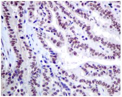 Immunohistochemical analysis of paraffin-embedded Human thyroid gland carcinoma tissue labeling ILF2 with ab154791 at 1/50 dilution.