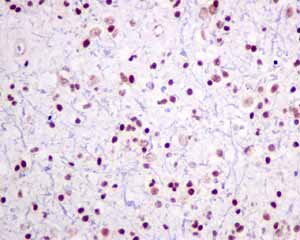 Immunohistochemical analysis of paraffin embedded Human glioma tissue using ab154791 showing +ve staining.