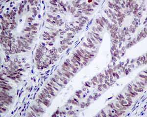 Immunohistochemical analysis of paraffin embedded Human endometrial carcinoma tissue using ab154791 showing +ve staining.