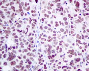 Immunohistochemical analysis of paraffin embedded Human ovarian carcinoma tissue using ab154791 showing +ve staining.