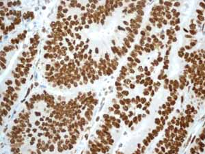 Immunohistochemical analysis of paraffin embedded Human Endometrial carcinoma tissue using ab133354 showing +ve staining.