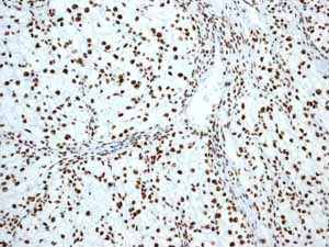 Immunohistochemical analysis of paraffin embedded Human Clear cell carcinoma of kidney tissue using ab133354 showing +ve staining.