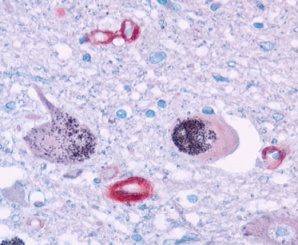 IHC with a indirect immunoalkaline phosphatase (APAAP) technique using ab3523. Shows iNOS expression within vessels walls in the Locus Coeruleus after death from septic shock. Picture kindly given to us by Prof. Djillali Annane. 