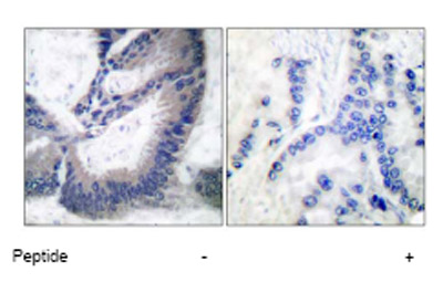 Immunohistochemical analysis of paraffin-embedded human lung carcinoma tissue using ab53769 at a 1/50 dilution.Left image un-treated.Right image treated with peptide.