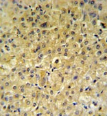 Immunohistochemical analysis of INSC in formalin fixed and paraffin embedded hepatocarcinoma tissue using ab102953 at a 1/50 dilution, followed by a peroxidase conjugated secondary antibody and DAB staining.