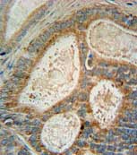 Immunohistochemical analysis of formalin-fixed, paraffin-embedded Human prostate carcinoma tissue labeling Insig1 with ab175856 at 1/50 dilution, followed by peroxidase conjugation of the secondary antibody and DAB staining.
