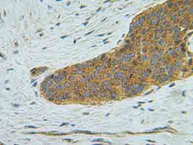 ab9807 staining IP10 in human carcinoid tissue section by Immunohistochemistry (Formalin/PFA fixed paraffin-embedded sections). Tissue underwent heat mediated antigen retrieval in sodium citrate buffer (pH 6.0). The primary antibody was used at 1.0 ug/ml and incubated with sample at 4°C overnight. A HRP-labeled polymer detection system was used with a DAB chromogen