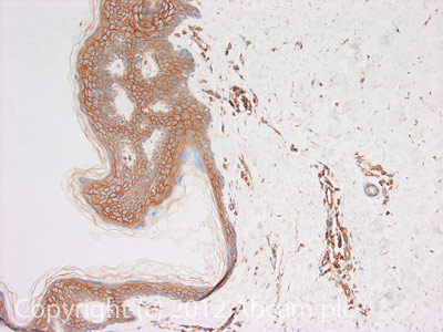 IHC image of IQGAP1 staining in Human skin melanoma formalin fixed paraffin embedded tissue section, performed on a Leica BondTM system using the standard protocol F. The section was pre-treated using heat mediated antigen retrieval with sodium citrate buffer (pH6, epitope retrieval solution 1) for 20 mins. The section was then incubated with ab110203, 1µg/ml, for 15 mins at room temperature and detected using an HRP conjugated compact polymer system. DAB was used as the chromogen. The section was then counterstained with haematoxylin and mounted with DPX.For other IHC staining systems (automated and non-automated) customers should optimize variable parameters such as antigen retrieval conditions, primary antibody concentration and antibody incubation times.