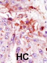 ab5522 staining IRAK in human hepatocarcinoma (HC) tissue by Immunohistochemistry (Formalin/PFA-fixed paraffin-embedded sections).