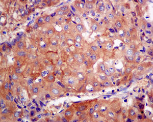 Immunohistochemical analysis of paraffin-embedded Human hepatocellular carcinoma tissue labeling PFDN1 with ab151708 at 1/100 dilution.