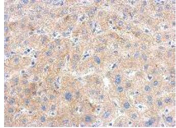 Immunohistochemical analysis of paraffin-embedded Hepatoma, labeling PGK1 using ab154613 at 1/500 dilution.