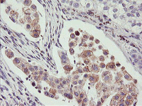 ab119249, at 1/150, staining PHF21B in paraffin-embedded Human Lung Carcinoma tissue by Immunohistochemistry.