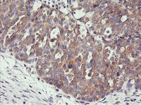 ab119249, at 1/150, staining PHF21B in paraffin-embedded Human Ovary Adenocarcinoma tissue by Immunohistochemistry.