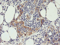 ab119249, at 1/150, staining PHF21B in paraffin-embedded Human Pancreas Carcinoma tissue by Immunohistochemistry.