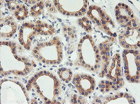 ab119249, at 1/150, staining PHF21B in paraffin-embedded Human Thyroid Carcinoma tissue by Immunohistochemistry.