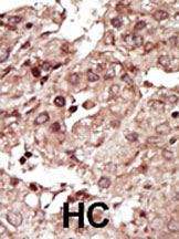 Immunohistochemical analysis of PHKG1 expression in formalin fixed and paraffin embedded human hepatocarcinoma tissue section using 1/50 ab37982.