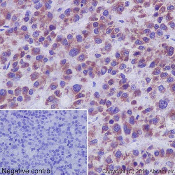 Immunohistochemical analysis of paraffin-embedded Human hepatocellular carcinoma tissue labeling PHKG1 with ab194112 at 1/250 dilution, followed by prediluted HRP Polymer for Rabbit/Mouse IgG. Counter stained with Hematoxylin.