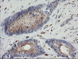 Immunohistochemical analysis of paraffin-embedded Human colon adenocarcinoma tissue labelling PHKG2 with ab131662 at 1/150 dilution.