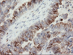 Immunohistochemical analysis of paraffin-embedded Human ovary adenocarcinoma tissue labelling PHKG2 with ab131662 at 1/150 dilution.