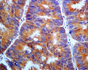Immunohistochemical analysis of PHLDA1 in paraffin embedded Human colon carcinoma tissue labelled with ab133654 at a 1/50 dilution.