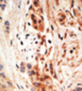 Formalin-fixed and paraffin-embedded human breast cancer tissue reacted with ab38641, which was peroxidase-conjugated to the secondary antibody, followed by AEC staining.