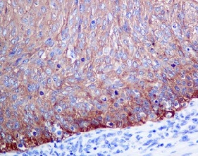 Immunohistochemical analysis of paraffin-embedded Human cervical carcinoma tissue labelling PHO1 with ab150369 at 1/250 dilution.