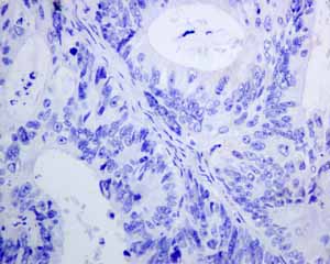 Immunohistochemical analysis of paraffin embedded Human Colonic adenocarcinoma tissue using ab150369 showing -ve staining.