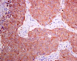 Immunohistochemical analysis of paraffin embedded Human Lung carcinoma tissue using ab150369 showing +ve staining.