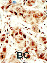 ab5453 staining PI 3 Kinase catalytic subunit alpha in human breast carcinoma (BC) tissue by Immunohistochemistry (Formalin/PFA-fixed paraffin-embedded sections).
